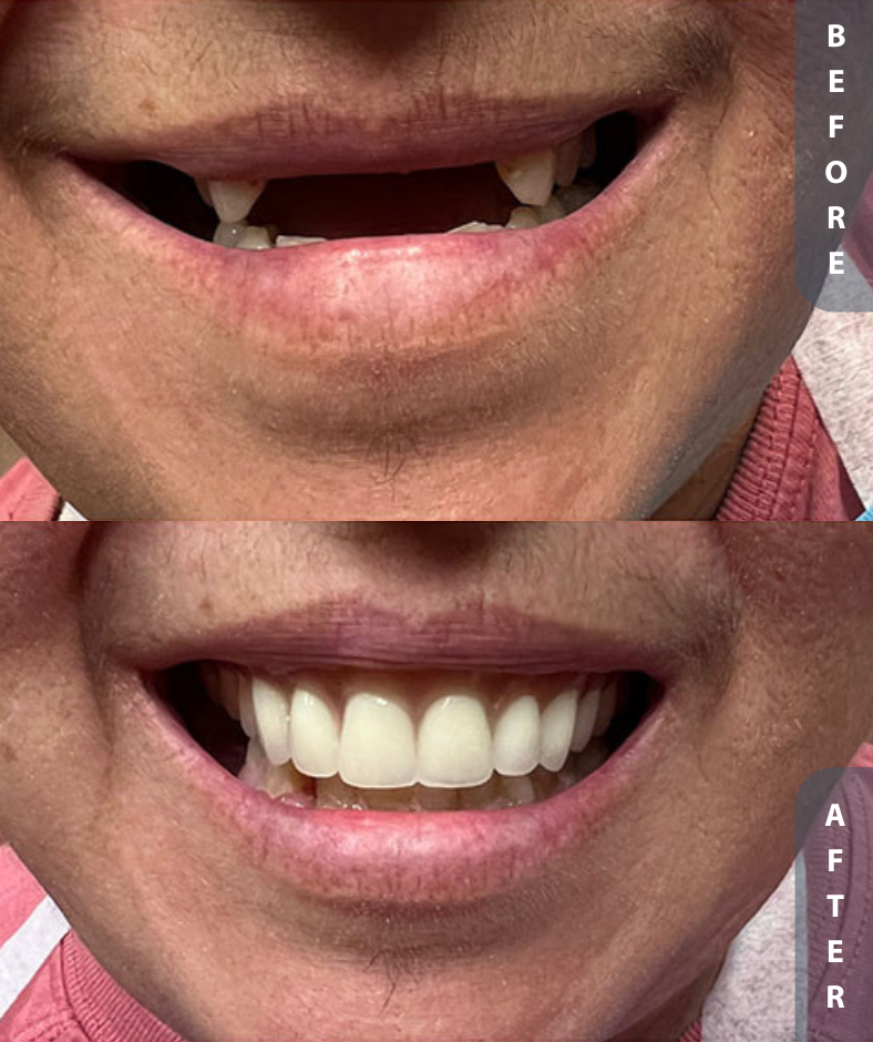 implant smile restoration