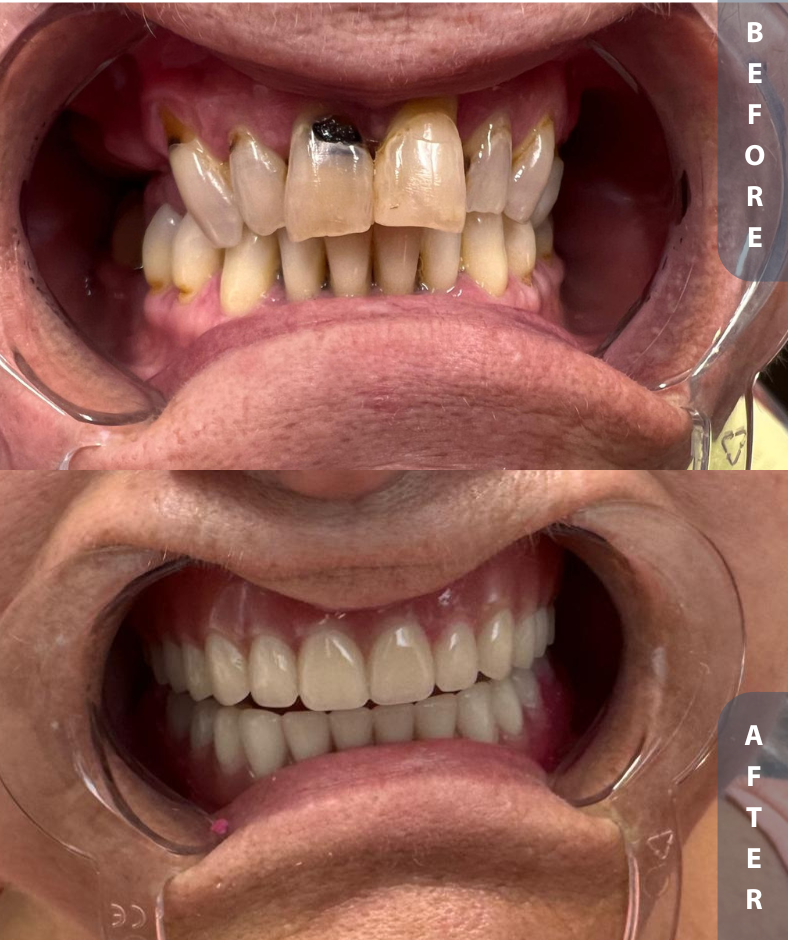 implant smile restoration