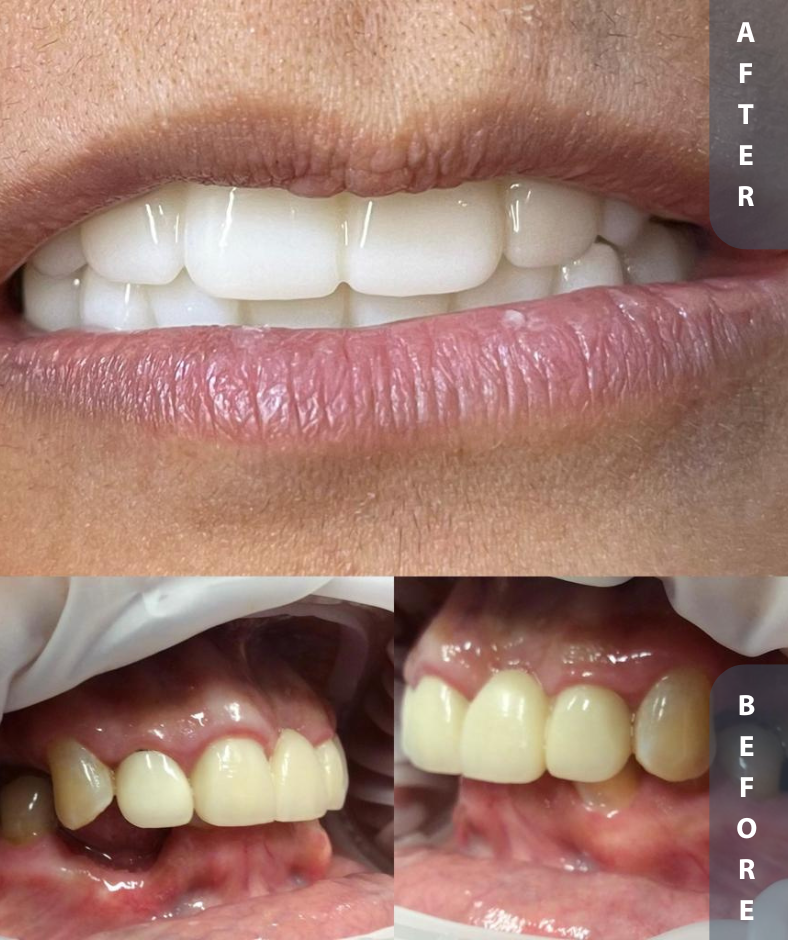 implant smile restoration