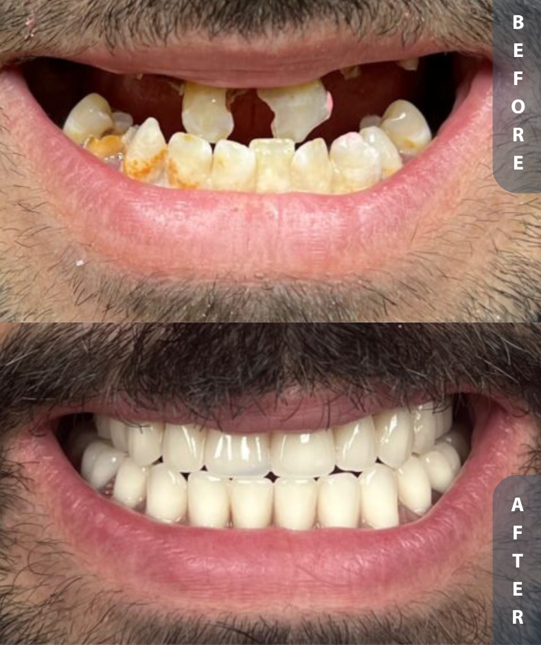 implant smile restoration