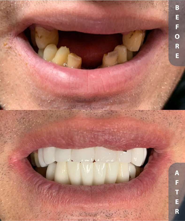 implant smile restoration