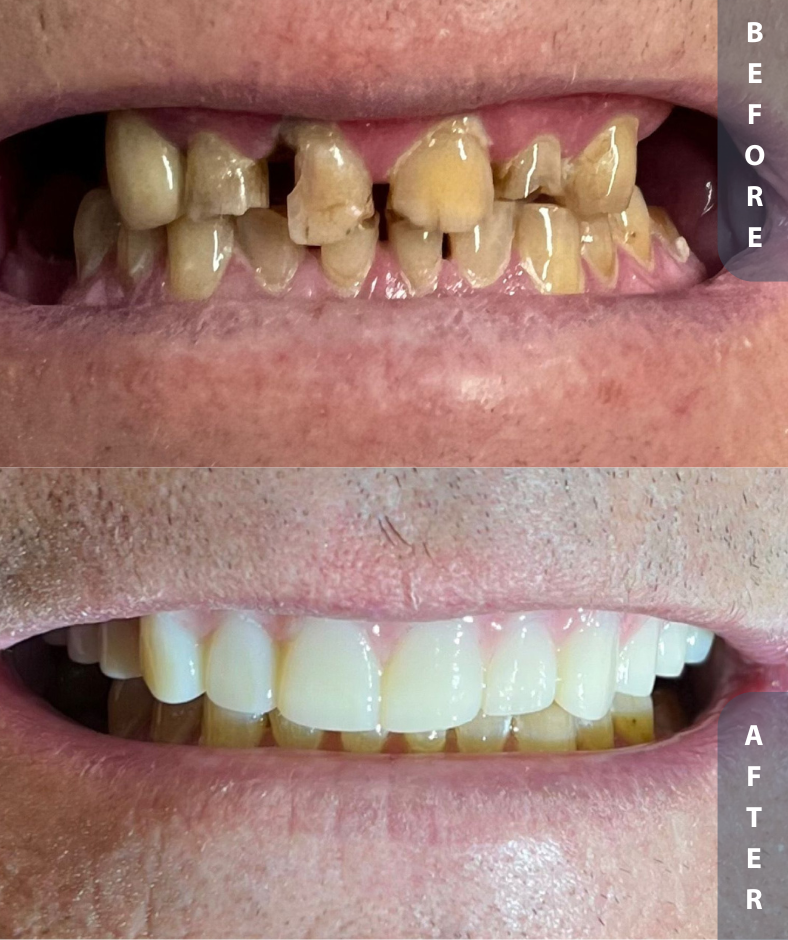 implant smile restoration