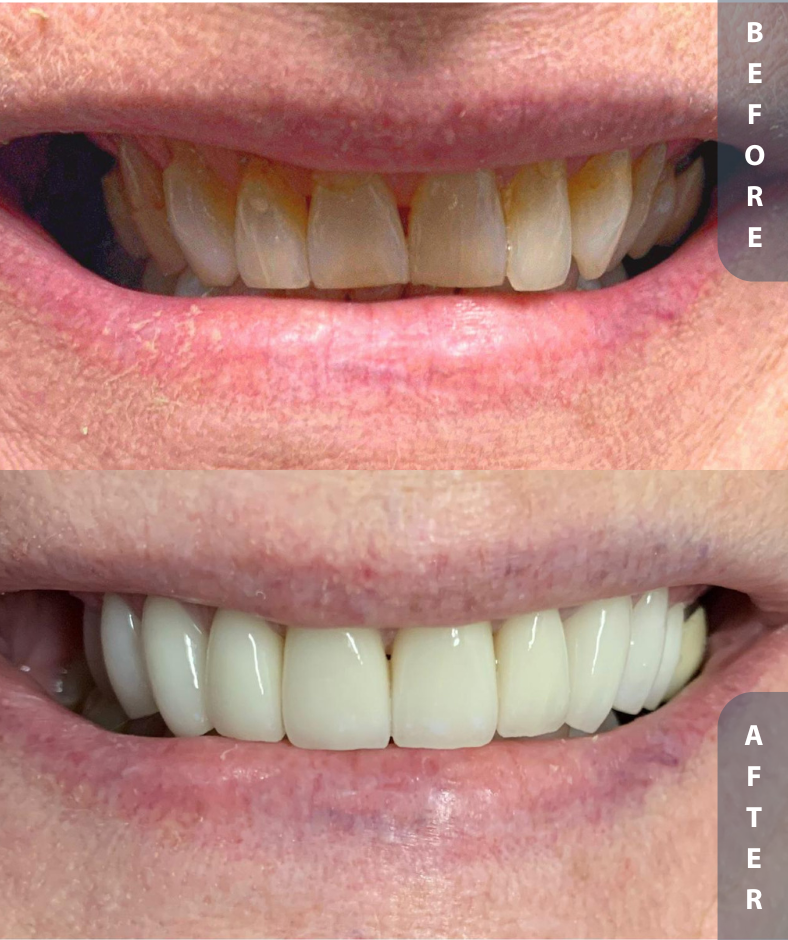 implant smile restoration