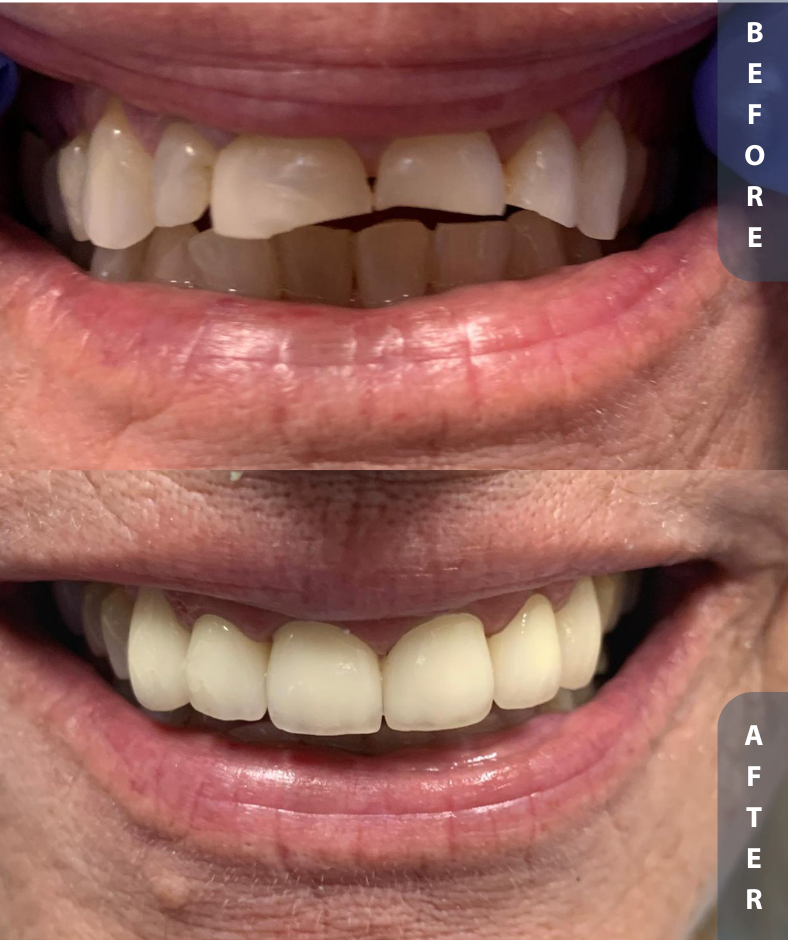 implant smile restoration