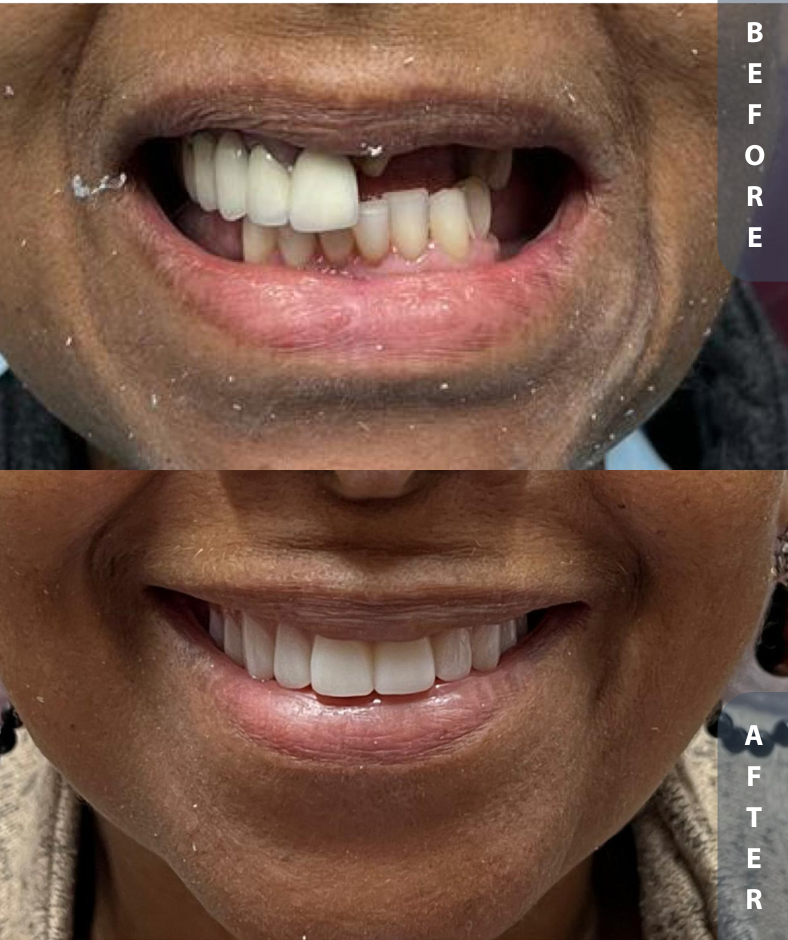 implant smile restoration