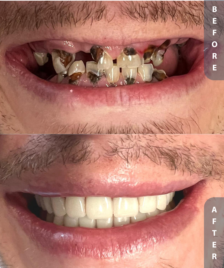 implant smile restoration