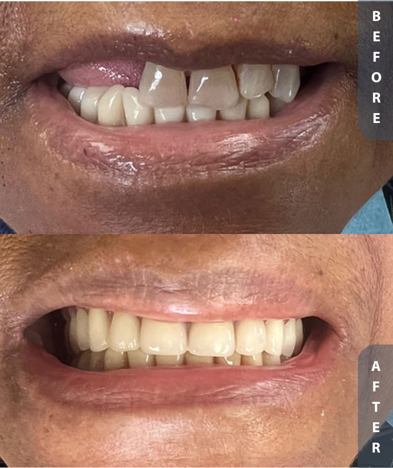 implant smile restoration