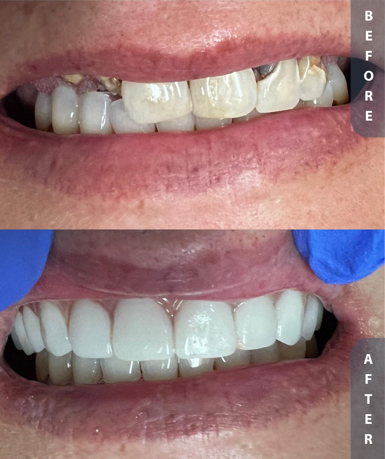 Dental Implants Before and After
