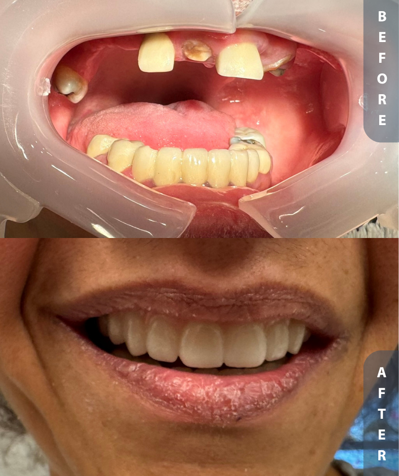 Sucheta FFA Before and After