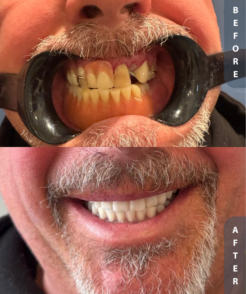 Overdentures Before and After