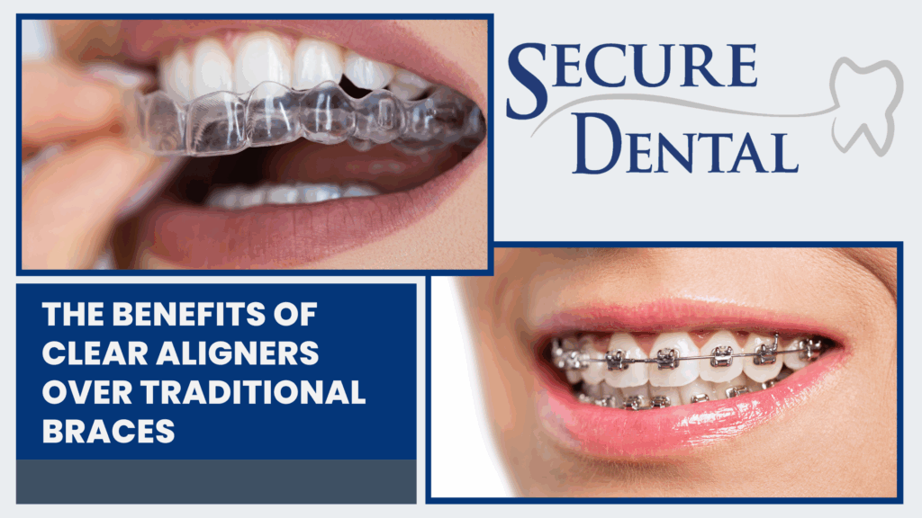 The Benefits of Clear Aligners Over Traditional Braces – Secure Dental