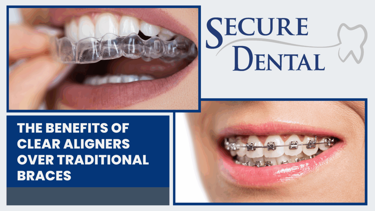 The Benefits of Clear Aligners Over Traditional Braces The Benefits of Clear Aligners Over Traditional Braces