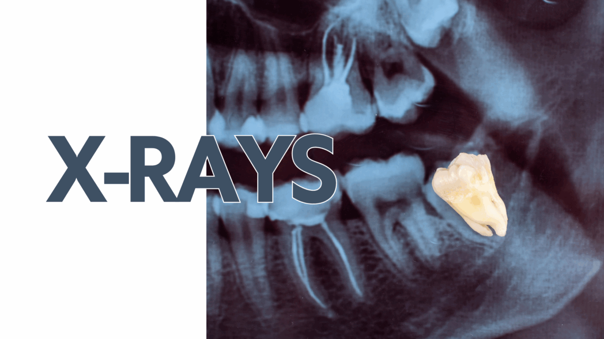 Dental X-Rays: Why They Matter for Your Teeth
