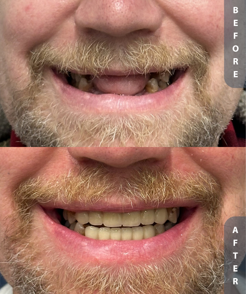 Smile Gallery Fixed Bridge