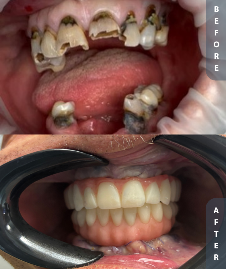 Smile Gallery Before and After FFA