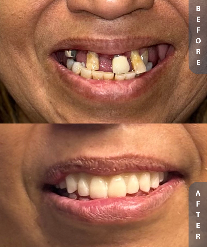 Smile Gallery FFA Upper