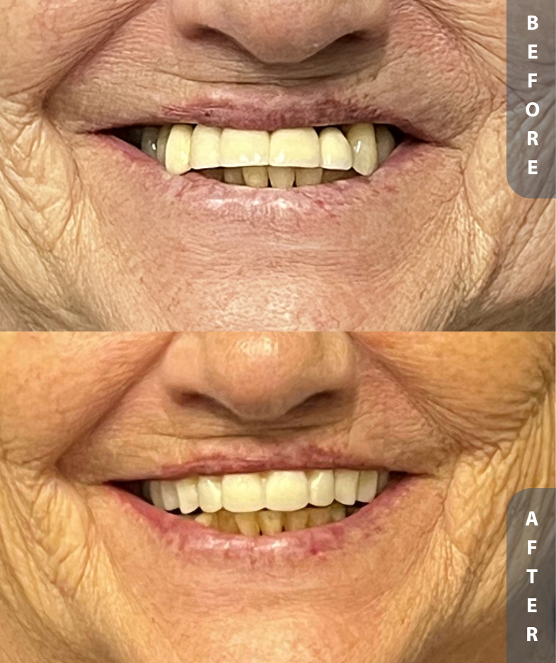 Smile Gallery Upper Zirc FFA