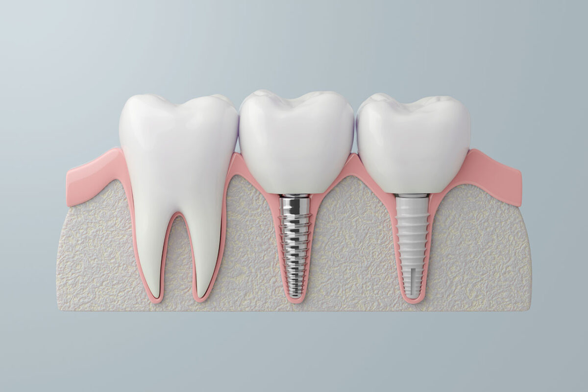 Dental Implants: A Strong, Natural-Feeling Way to Replace Missing Teeth