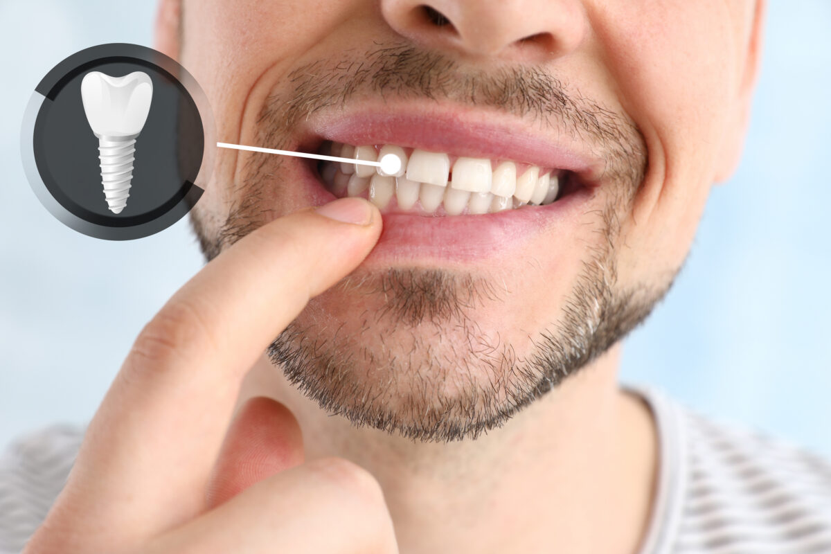 Dental Implants: The Strong, Natural-Feeling Way To Replace Missing Teeth