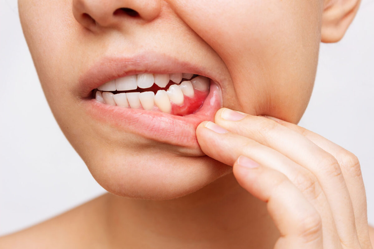 My Gums Bleed When I Brush. Is That Serious? Ask Secure Dental Why Do My Gums Bleed? Your Questions Answered