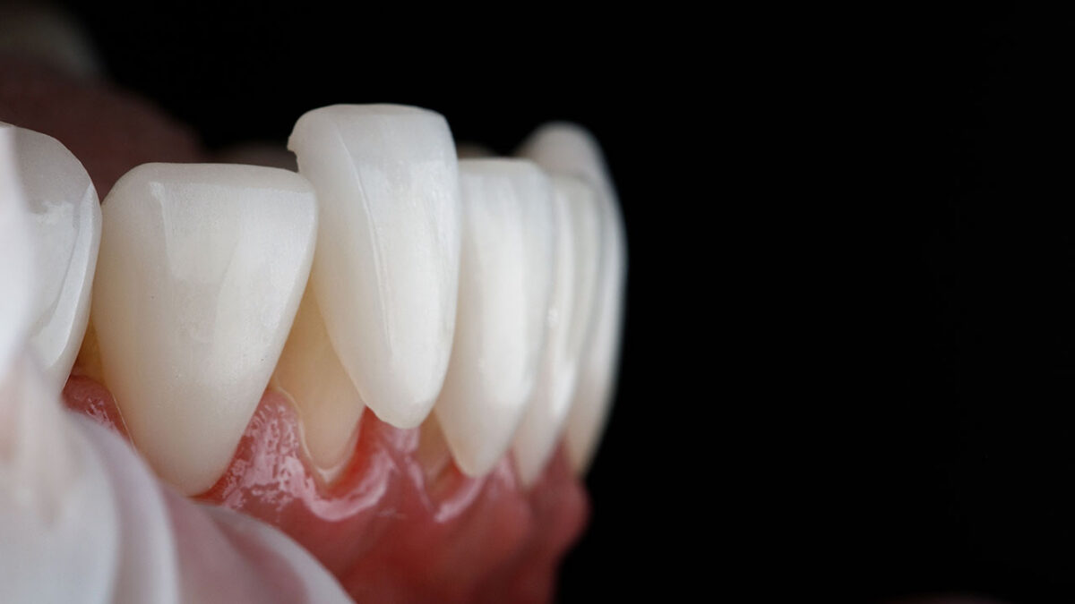What’s the Difference Between a Crown and a Veneer? Ask Secure Dental What’s the Difference Between a Crown and a Veneer? Ask Secure Dental
