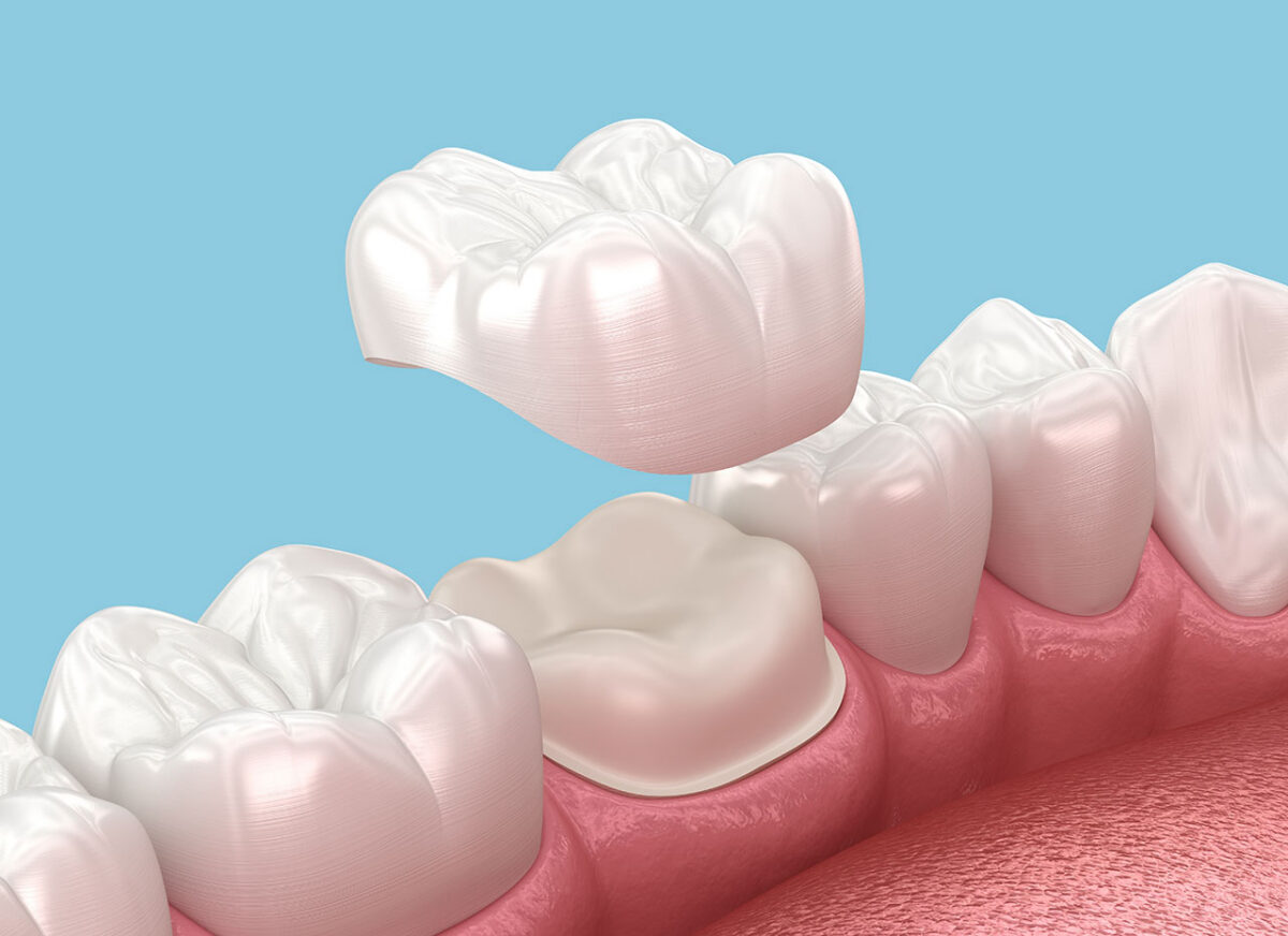 Do I Need a Crown, or Can I Just Get a Filling? Ask Secure Dental