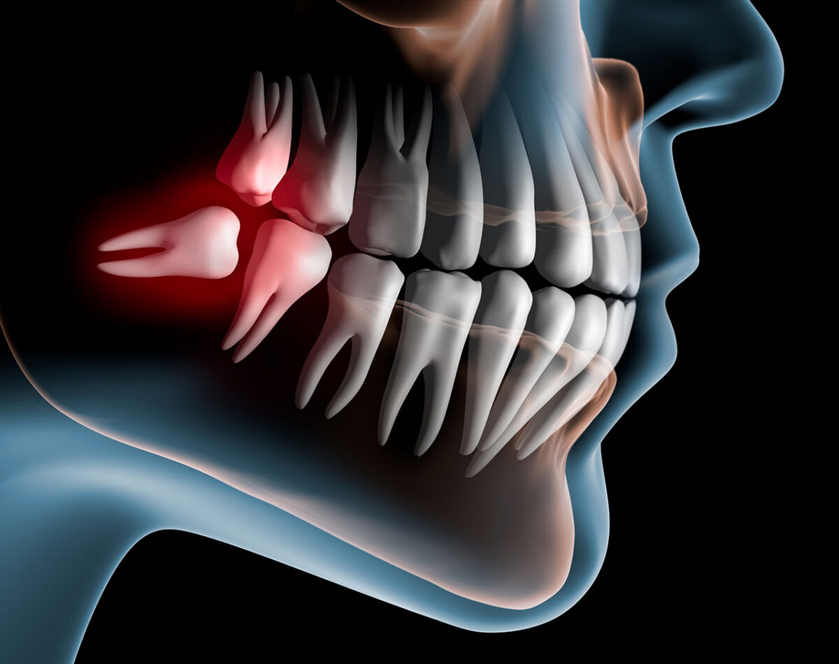 Do Wisdom Teeth Always Need to Come Out? Ask Secure Dental