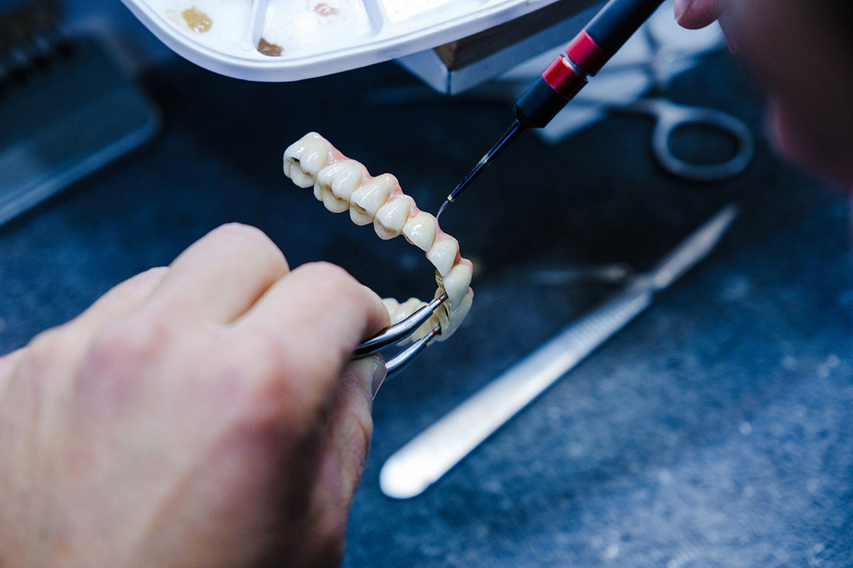 I’m Missing Several Teeth. Do I Need an Implant for Every Tooth? Ask Secure Dental