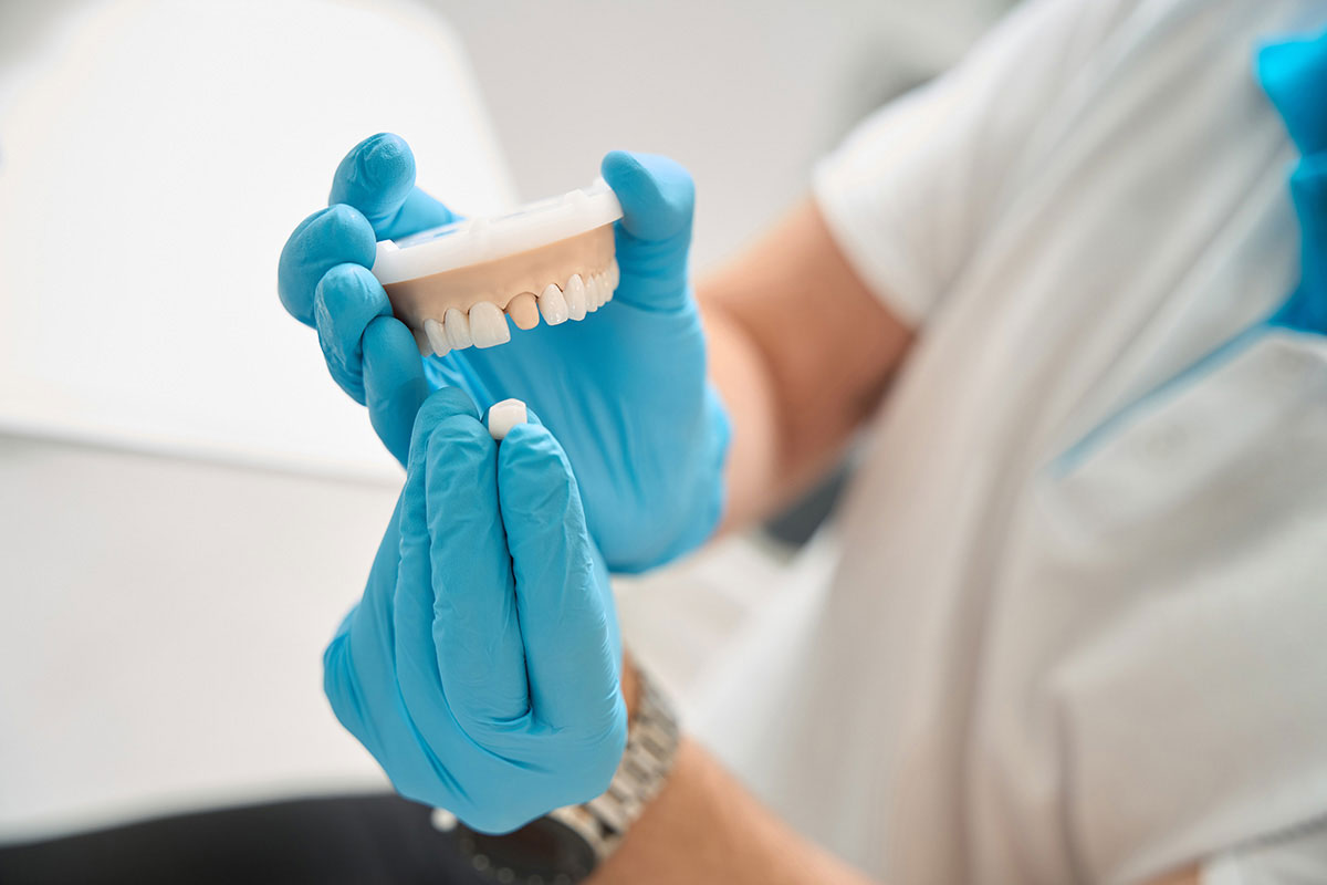 My Dental Crown Fell Off. What Should I Do? Ask Secure Dental