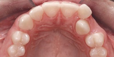 Patients top teeth before clear aligners