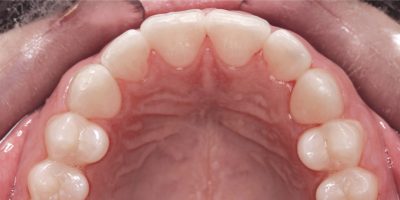 Upper arch in mouth after clear aligners