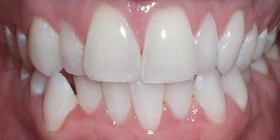 Patients teeth before their clear aligner treatment