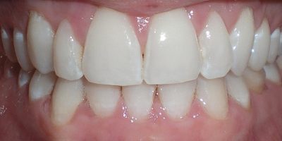 Patients teeth after their clear aligner treatment