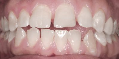 Patients bite before they had clear aligners