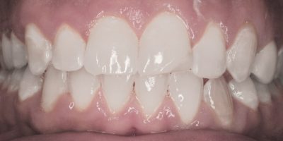 Patients bite after they had clear aligners