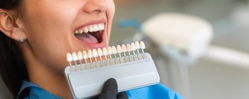 A beautiful young patient uses a dental tooth shade guide for whitening teeth service to ensure a perfect choice of color. Bleaching, prosthetics, orthopedic dentistry concept.